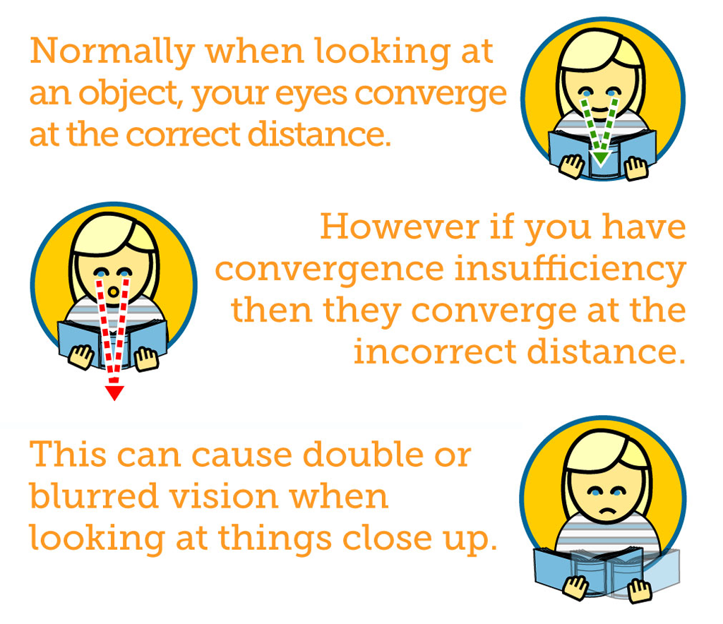 Convergence Insufficiency Description Graphic